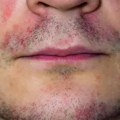 Nahaufnahme eines männlichen Gesichts mit Rötungen und trockener Gesichtshaut um den Mundbereich.