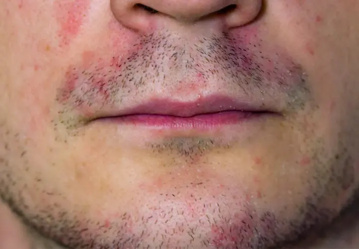 Nahaufnahme eines männlichen Gesichts mit Rötungen und trockener Gesichtshaut um den Mundbereich.