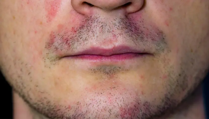 Nahaufnahme eines männlichen Gesichts mit Rötungen und trockener Gesichtshaut um den Mundbereich.