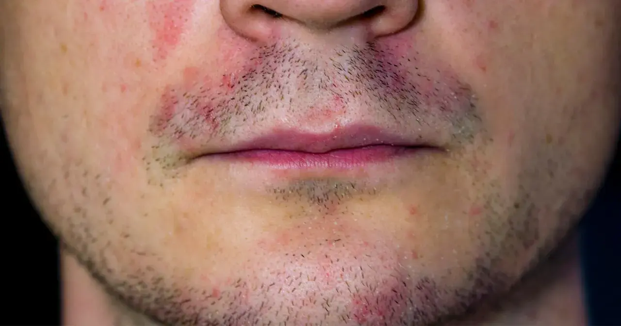 Nahaufnahme eines männlichen Gesichts mit Rötungen und trockener Gesichtshaut um den Mundbereich.